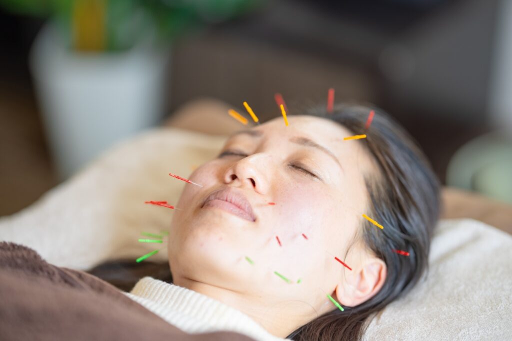 優しい美容鍼の施術